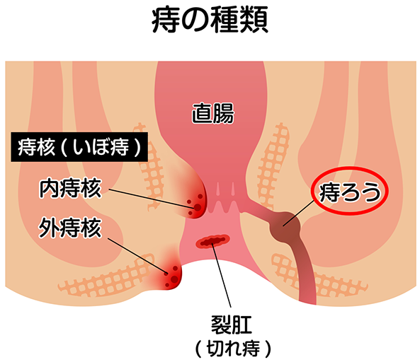 痔ろう（あな痔）とは