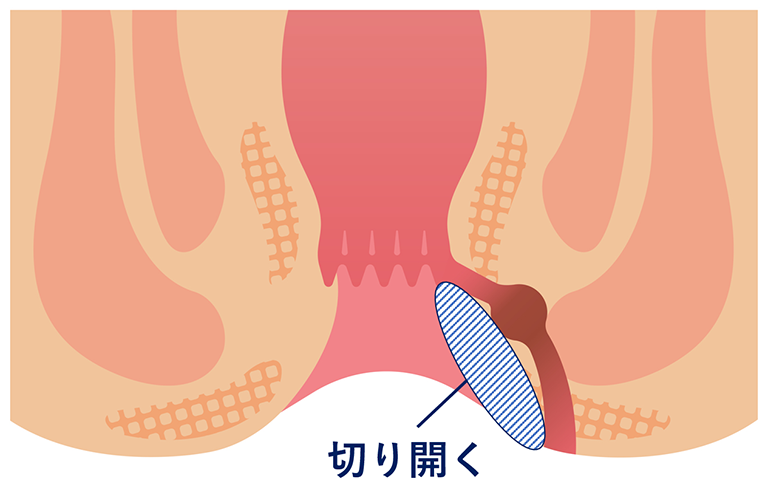 切開開放術（lay open法）