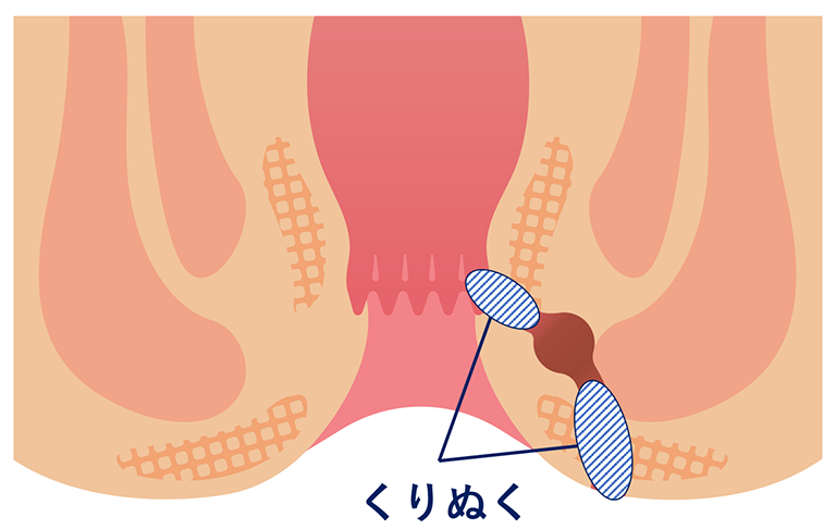 括約筋温存手術（coring out法）