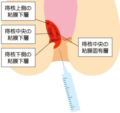 硬化療法：ジオン注射療法（ALTA療法）