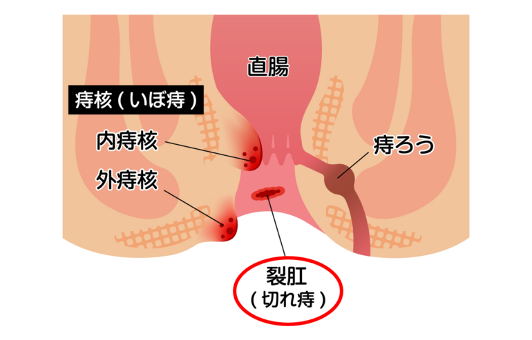 切れ痔（裂肛）