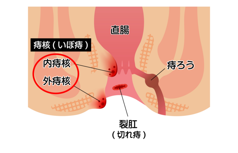 いぼ痔（内痔核・外痔核・嵌頓（かんとん）痔核）