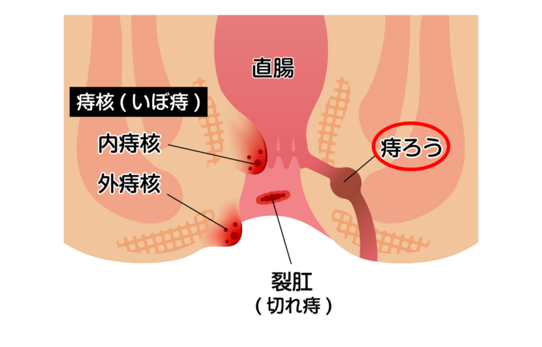 痔ろう（あな痔）