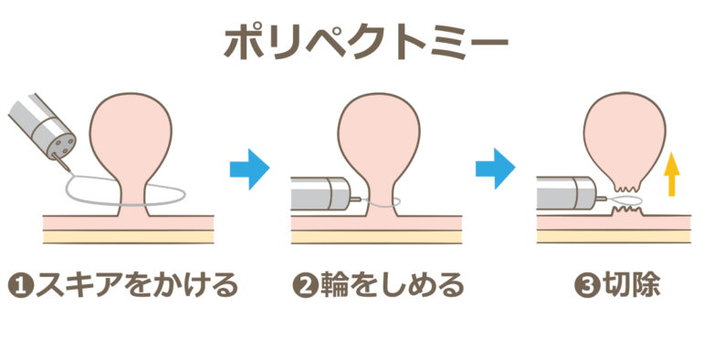 ポリペクトミー（HSP：hotsnarepolypectomy）