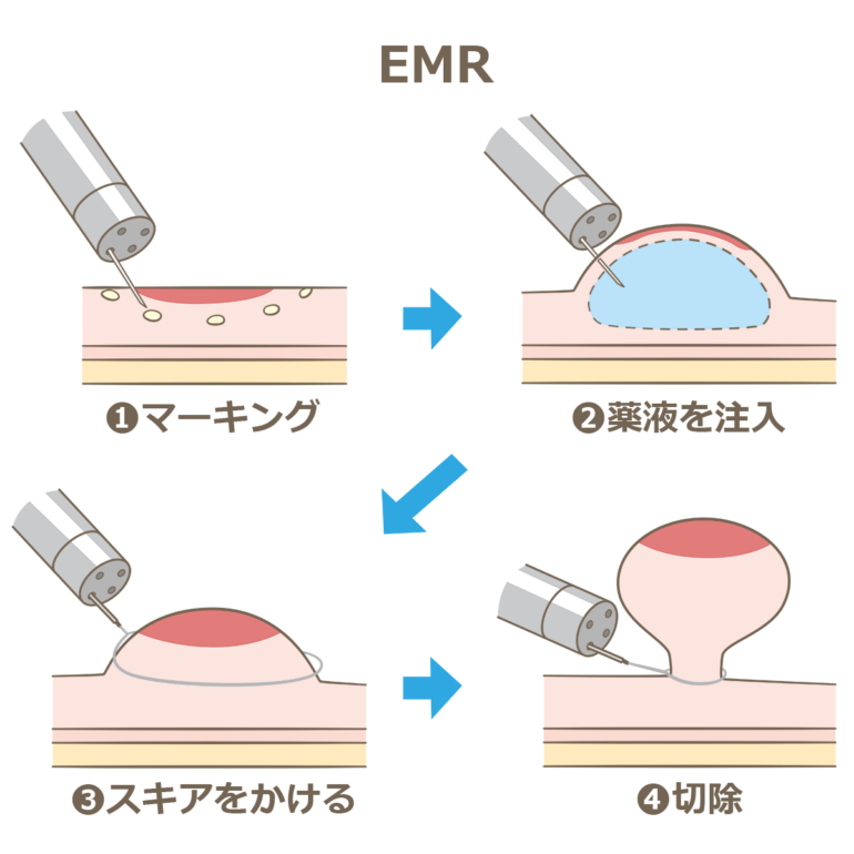 内視鏡的粘膜切除術（EMR;endoscopicmucosalresection）